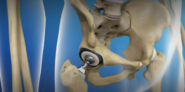 Hip Joint Replacement in Bhopal